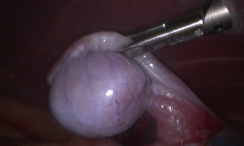 Image 13 Cryptorchid testicle in abdomen