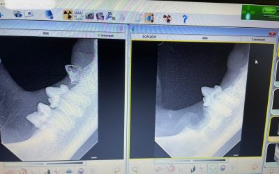 Xrays show premolar crown & roots resorbed and hole in back molar crown