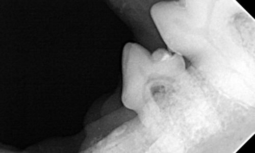 X-ray shows resorptive roots of premolar tooth
